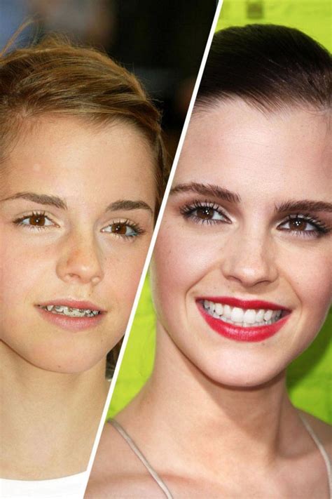 Famous Faces With Braces Celebrities With Braces Perfect Smile Celebrity Smiles