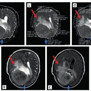 Rhabdoid Meningioma WHO Grade III ICD 9358 3 A T1WI B T2WI C