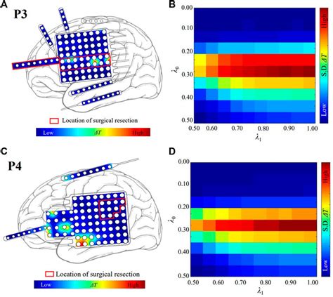 Frontiers Localizing Targets For Neuromodulation In Drug Resistant