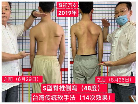 脊柱侧弯 脊柱侧弯 成功案例 广东脊祥万岁健康管理有限公司