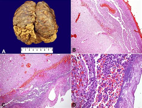 A-Gross appearance of the brain, showing thickened meninges with ...