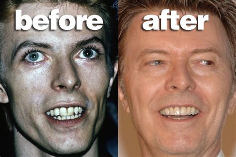 David Bowie | Perfect teeth, Celebrity smiles, Cosmetic dentistry