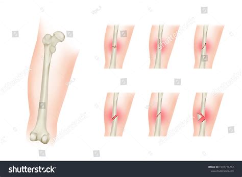 Types Bone Fractures Femoral Shaft Fracture 库存插图 1997776712 Shutterstock