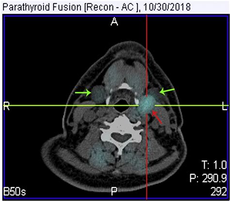 Ectopic Parathyroid Adenoma In The Submandibular Region A Case Report