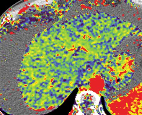 Quantitative Color Mapping Of The Arterial Enhancement Fraction In