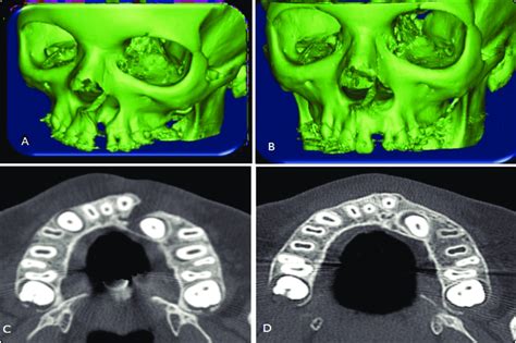 A B Showing D Scan Of The Alveolar Cleft Preoperatively And