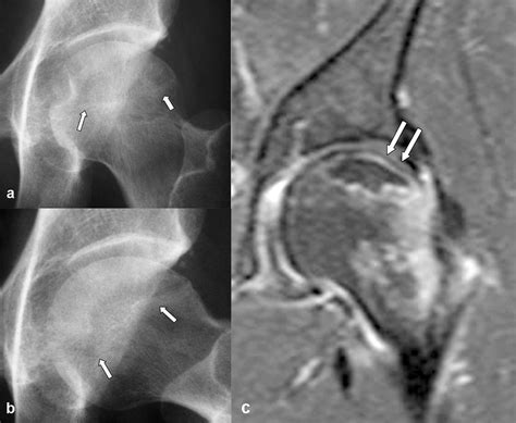 The Role Of Mr Imaging In Staging Femoral Head Osteonecrosis European