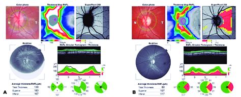 Preoperative And Postoperative Optic Coherence Tomography Oct Of The