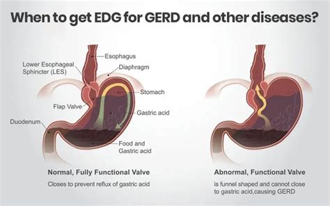 Gerd Endoscopy