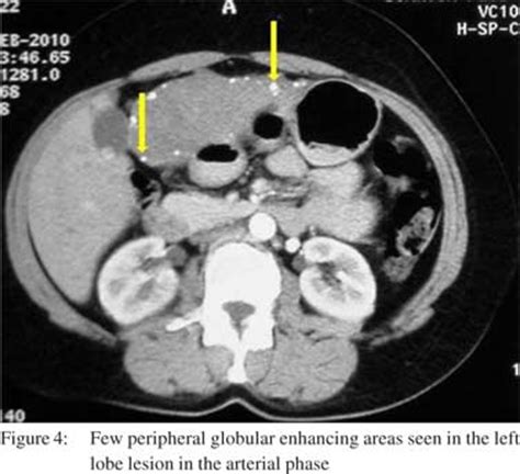 A rare case of atypical hemangioma showing centrifugal enhancement