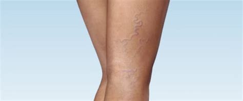 Laser Treatment For Spider Veins On Legs Sclerotherapy And Flickr