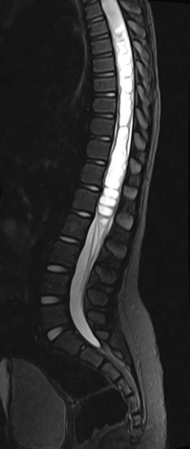 Spinal Cord Astrocytoma Image Radiopaedia Org