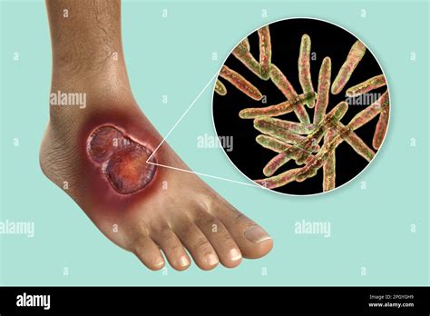 Úlcera De Buruli Y Mycobacterium Ulcerans Ilustración Fotografía De