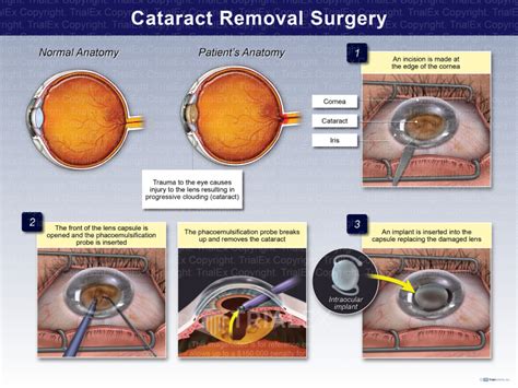 Cataract Removal Surgery - TrialQuest Inc.