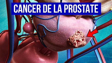 CANCER DE LA PROSTATE Explication Symptômes et Traitements YouTube