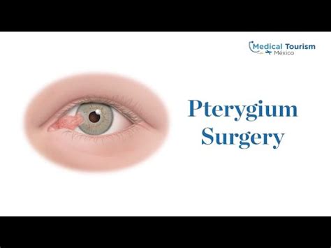 Getting Pterygium Surgery In Guadalajara Medical Tourism Youtube