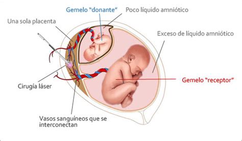 Semana 12 Del Embarazo Gemelar Monocorial Natalben