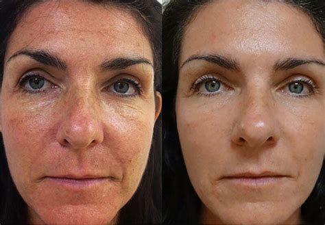 Laser Skin Resurfacing Bradford Myskyn