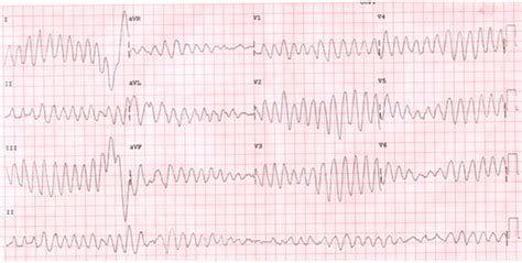 Torsades De Pointes Polymorphic Ventricular Tachycardia Characterized