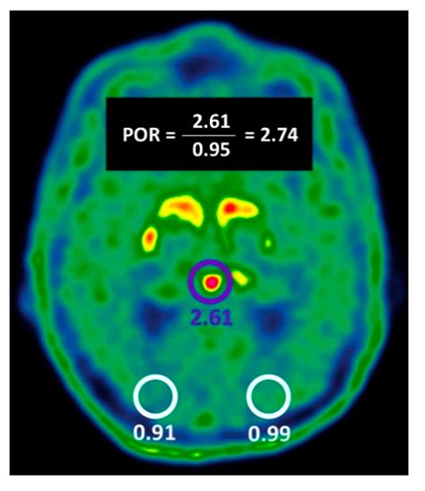 Ijms Free Full Text Beyond Visual Assessment Of Basal Ganglia