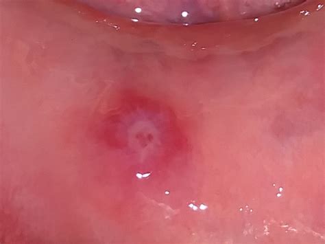 Mouth Ulcer_Symptoms