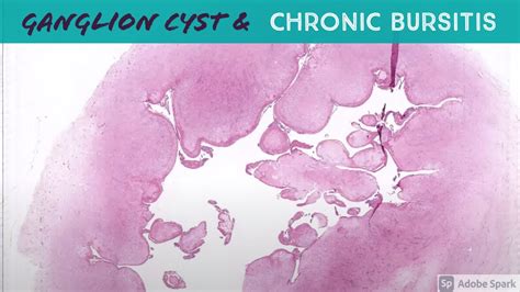 Ganglion Cyst Histology