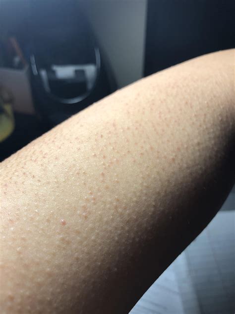 [skin Concerns] Any Help For Keratosis Pilaris Is Greatly Appreciated Skin On My Arms And