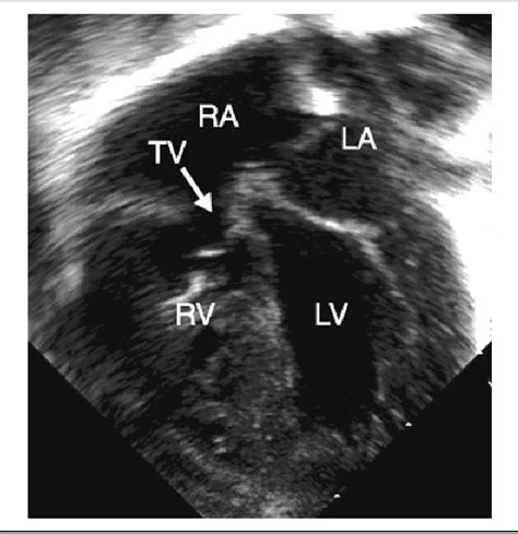 Figure 3 From Pulmonary Atresia With An Intact Ventricular Septum Preoperative Physiology