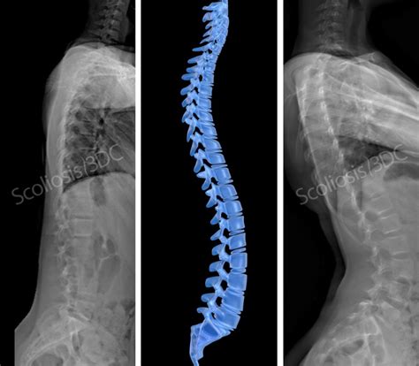 Sagittal Plane Of Scoliosis Scoliosis Side View Lateral X Ray