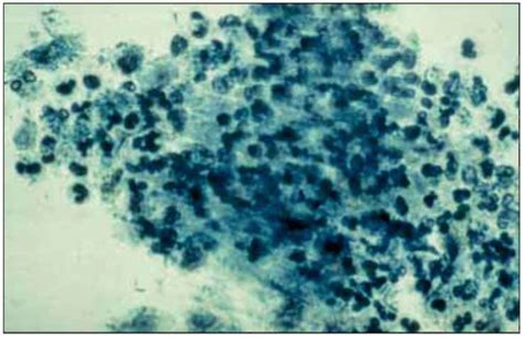 Fecal Wbc Prep With Stain