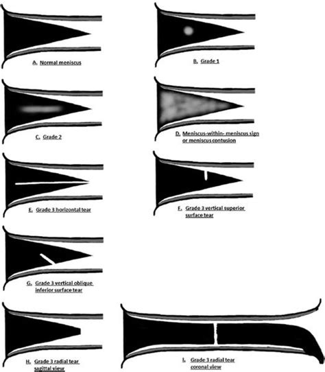 Meniscal Tear Grading Mri