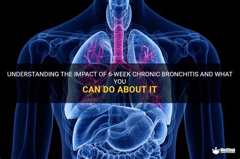 Understanding The Impact Of 6 Week Chronic Bronchitis And What You Can Do About It Medshun