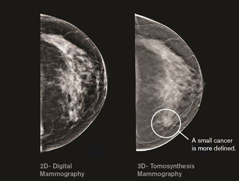 Advanced 3d Mammography Technology Now Available To Patients In Douglas County Carson Tahoe Health