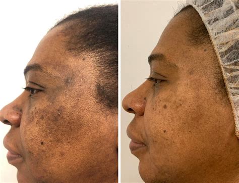 Witness The Transformation Hyperpigmentation Tretinoin Before And After