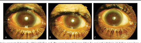 Figure 1 From Argon Laser Treatment For Symptomatic Inferior