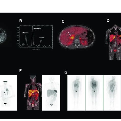 A This Is An Axial Diffusion Weighted Mri Image Showing A Right