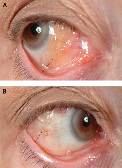 Conjunctival Granuloma Caused By Surgical Talc Journal Of American