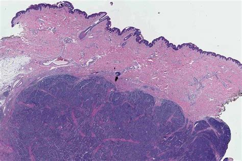 Merkel Cell Carcinoma Of Skin