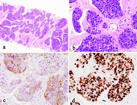 Liver Core Biopsy Showing A Poorly Differentiated Carcinoma With