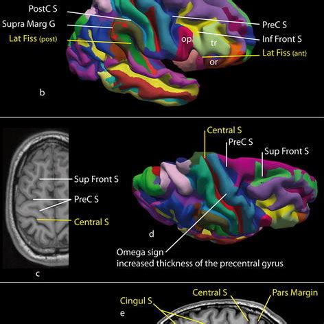 Identification Of The Main Sulci And Gyri Of The Dorsal Aspect Of The