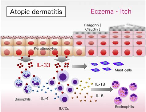 Il 33 Induced Atopic Dermatitis Like Inflammation In Mice Is Mediated