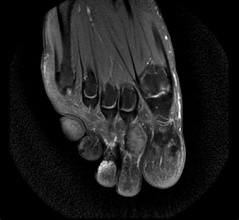 Giant Cell Tumor Of Tendon Sheath Image Radiopaedia Org