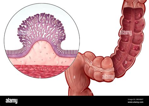 Sessile Colorectal Polyp Illustration Stock Photo Alamy