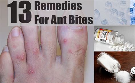 ant bites swelling - pictures, photos