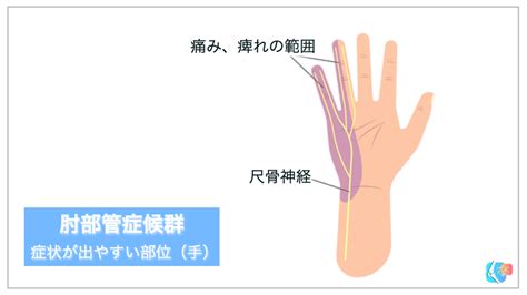 肘部管症候群（尺骨神経障害）とリハビリテーション