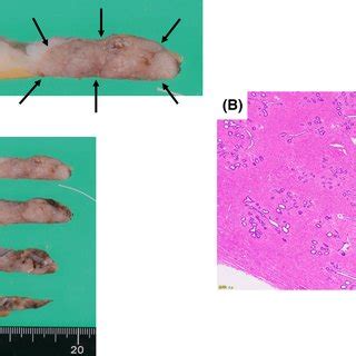 A Gross Appearance Of The Cut Surface Of The Resected Specimen An