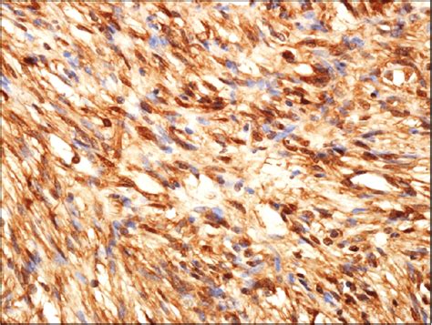 Immunohistochemical Findings Immunostaining Showed Diffuse Strong