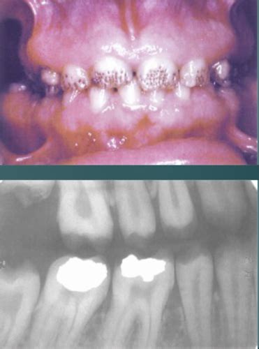 Genetics Of Tooth Disorders Part II Flashcards Quizlet