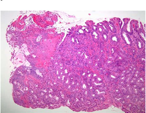 Figure From The Significance Of Gastric And Duodenal Histological