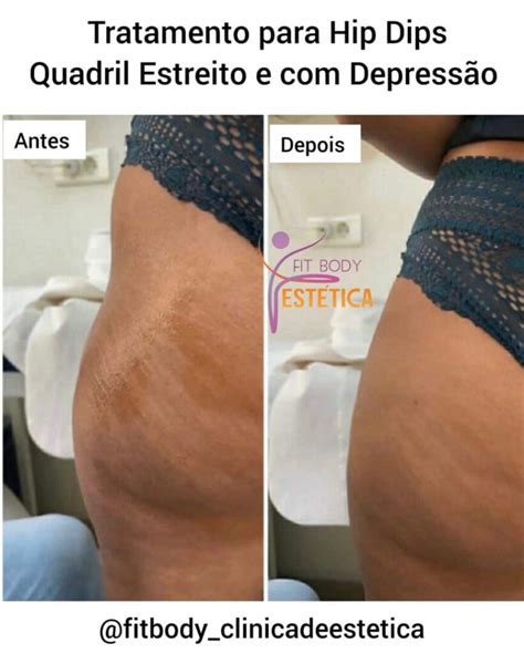 Hip Dips Quadril Estreito E Depress O Fit Body Est Tica